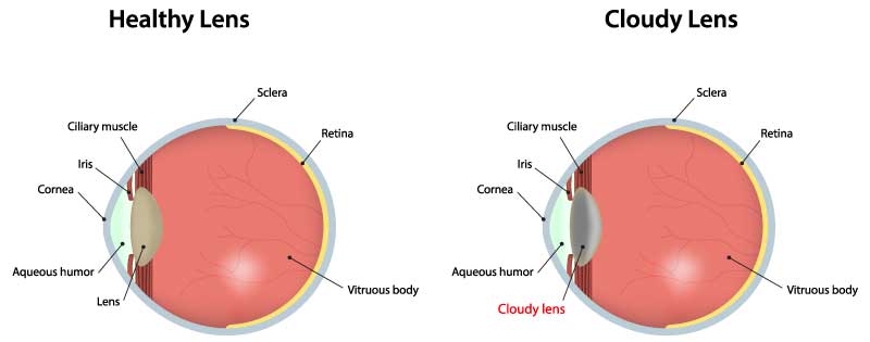 cataracts diagram